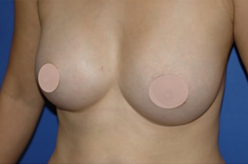 Case--3974 | After Breast Augmentation