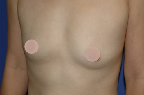 Case--3974 | Before Breast Augmentation