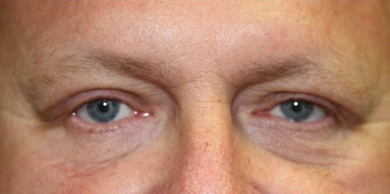 Case--5001 | After Blepharoplasty