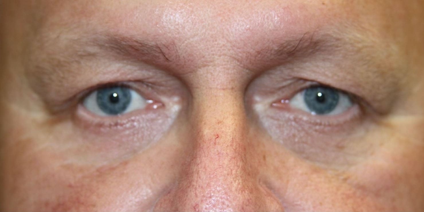 Case--5001 | Before Blepharoplasty