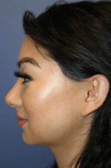 Case--5218 | After Forehead (Brow Bone) Reduction