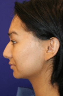 Case--5218 | Before Forehead (Brow Bone) Reduction