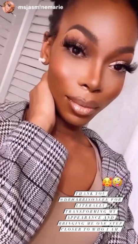 Case--5175 | After Cheek Augmentation