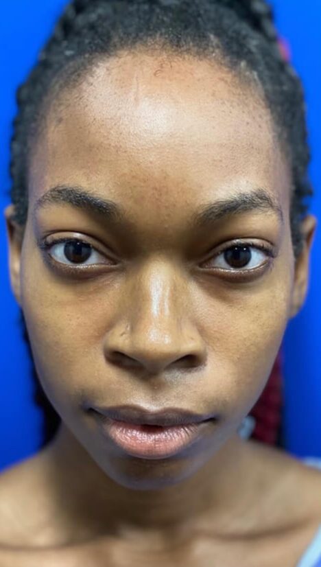 Case--5175 | Before Cheek Augmentation