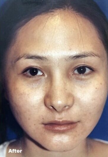 Case--5224 | After Cheek Reduction