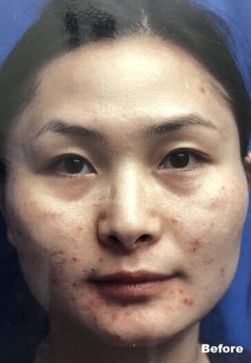 Case--5224 | Before Cheek Reduction