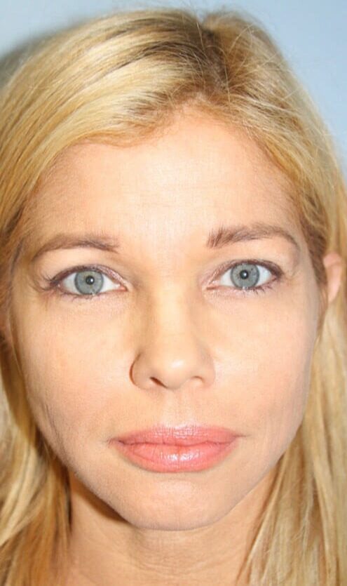 Case--3346 | Before Facelift