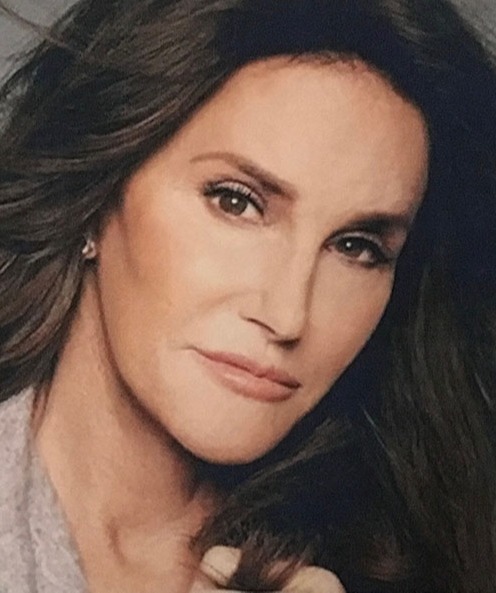 Case--4313 | After Facial Feminization Surgery