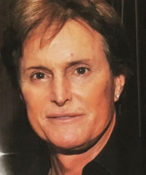 Case--4313 | Before Facial Feminization Surgery