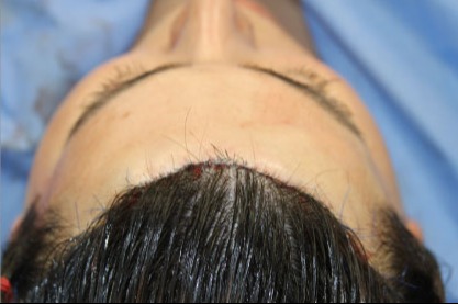 Case--2293 | After Hairline Advancement