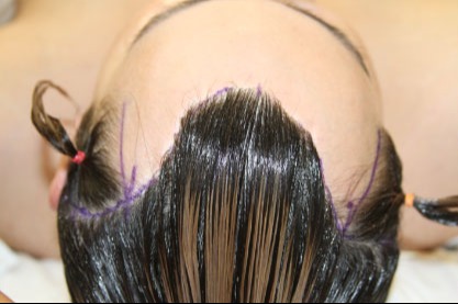 Case--2293 | Before Hairline Advancement