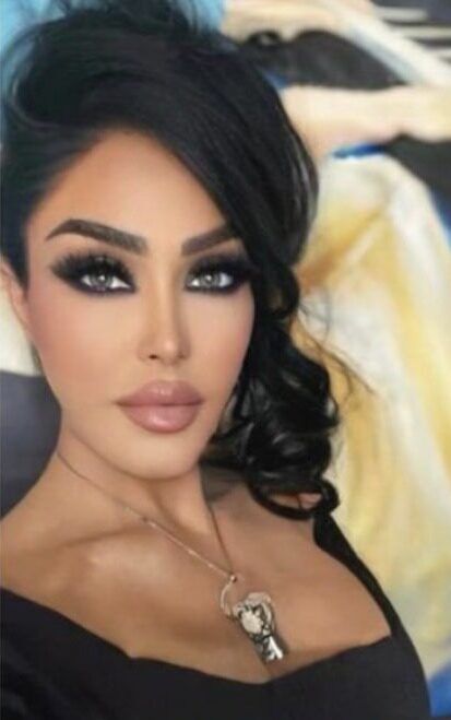 Case--3274 | After Jaw Reduction