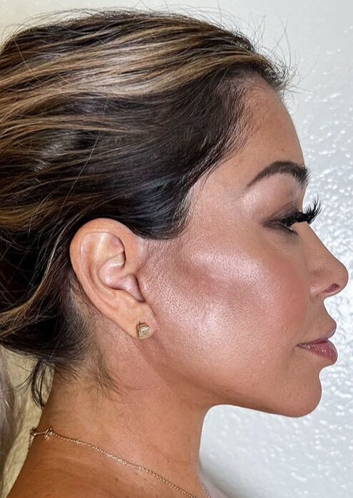 Case--2728 | After Neck Lift