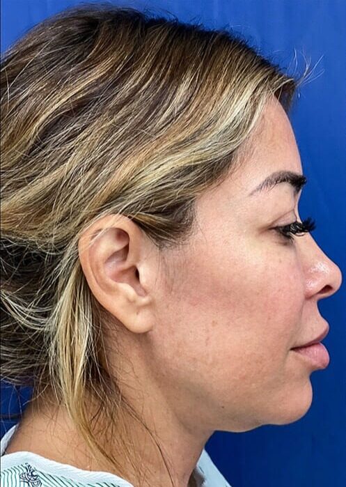 Case--2728 | Before Neck Lift