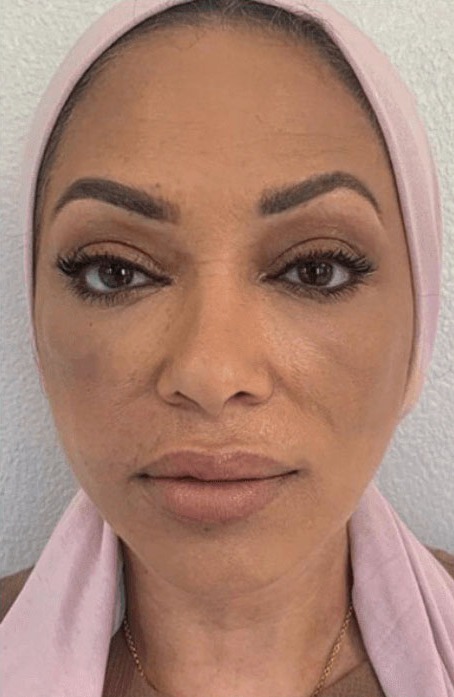 Case--1255 | After Facial Silicone Removal