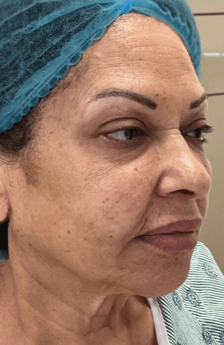 Case--1255 | Before Facial Silicone Removal