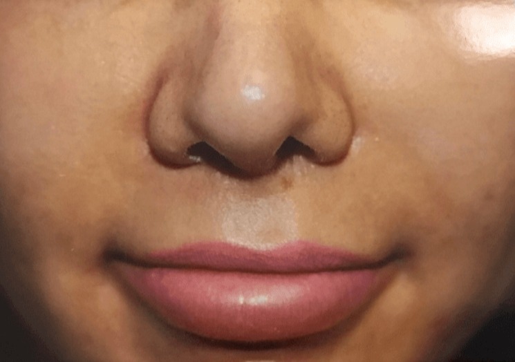 Case--3623 | Before Lip Augmentation