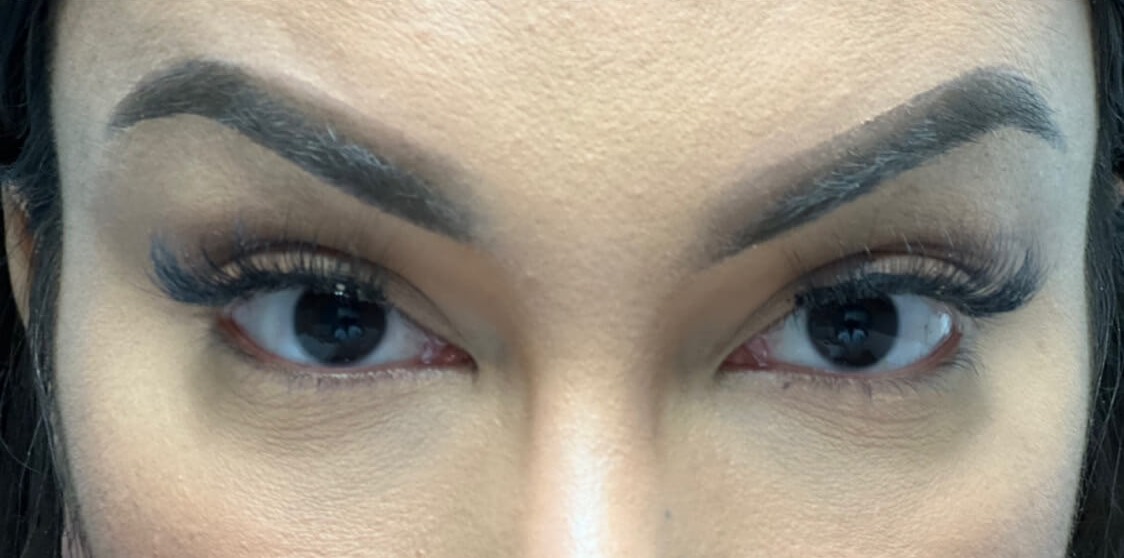 Case--2065 | After Brow Lift