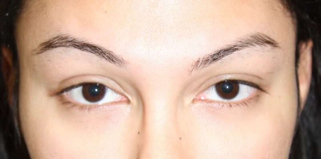 Case--2065 | Before Brow Lift