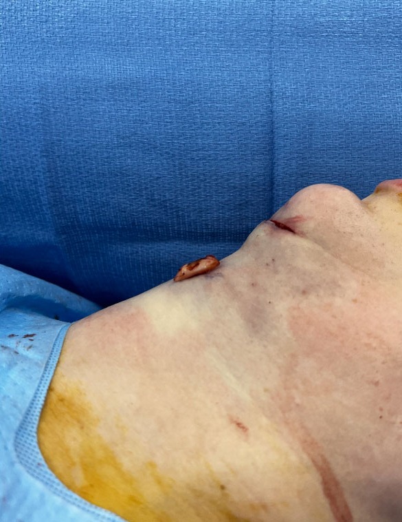 Case--3758 | After Thyroid Cartilage Shave