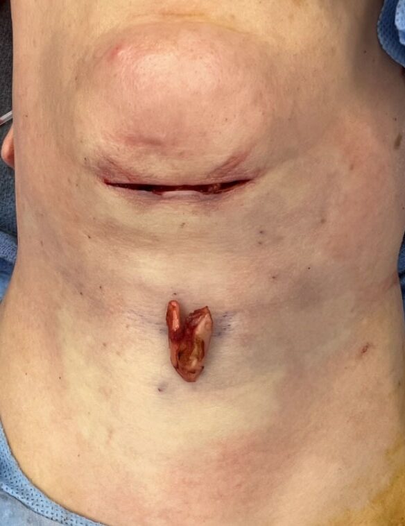 Case--3758 | Before Thyroid Cartilage Shave