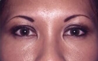 Case--1406 | After Blepharoplasty
