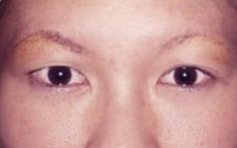Case--1406 | Before Blepharoplasty
