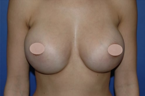 Case--4183 | After Breast Augmentation