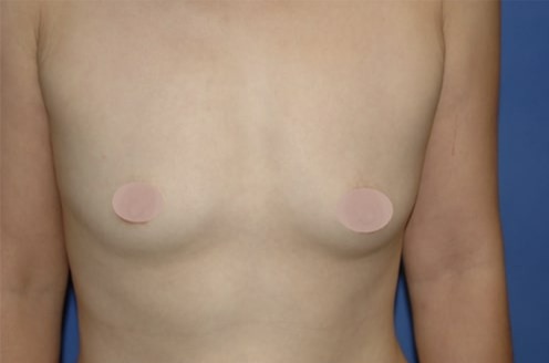 Case--4183 | Before Breast Augmentation