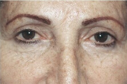 Case--3515 | After Blepharoplasty