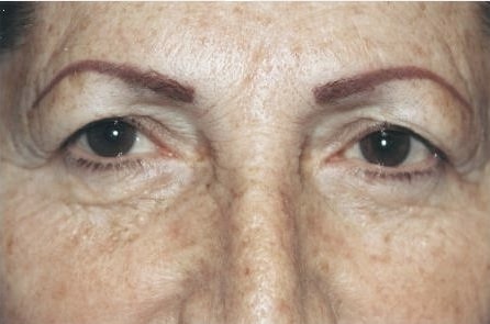 Case--3515 | Before Blepharoplasty