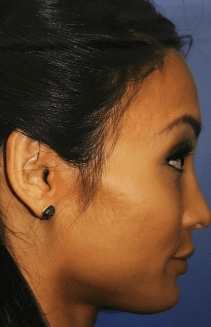 Case--1421 | After Forehead (Brow Bone) Reduction