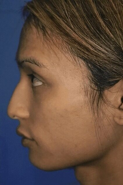 Case--5113 | Before Rhinoplasty