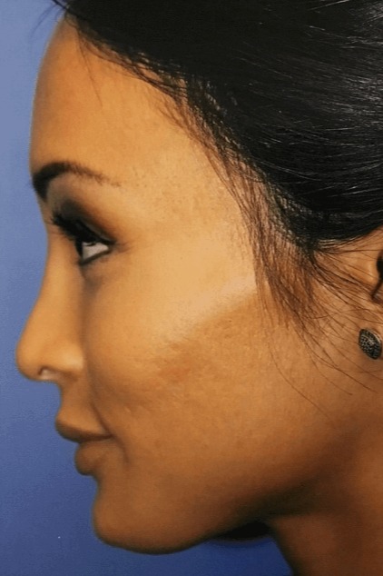 Case--5113 | After Rhinoplasty