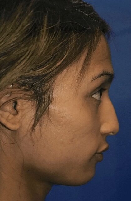 Case--1421 | Before Forehead (Brow Bone) Reduction