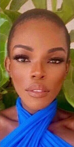 Case--5101 | After Rhinoplasty