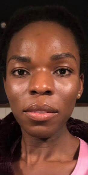 Case--5101 | Before Rhinoplasty