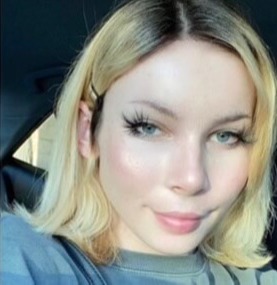 Case--4665 | After Cheek Augmentation