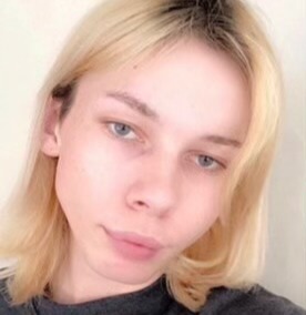 Case--4665 | Before Cheek Augmentation