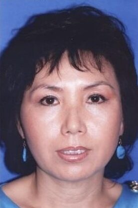 Case--2926 | After Cheek Reduction