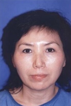 Case--2926 | Before Cheek Reduction