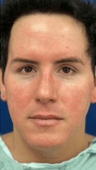 Case--7473 | Before Chin Reduction