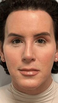 Case--7473 | After Chin Reduction