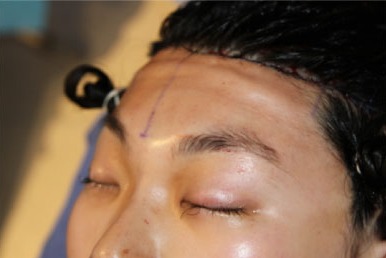 Case--8111 | After Hairline Advancement