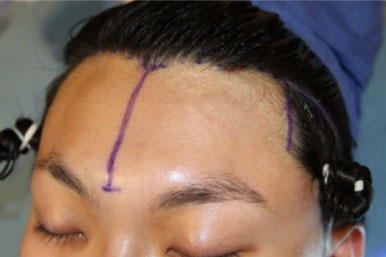 Case--8111 | Before Hairline Advancement