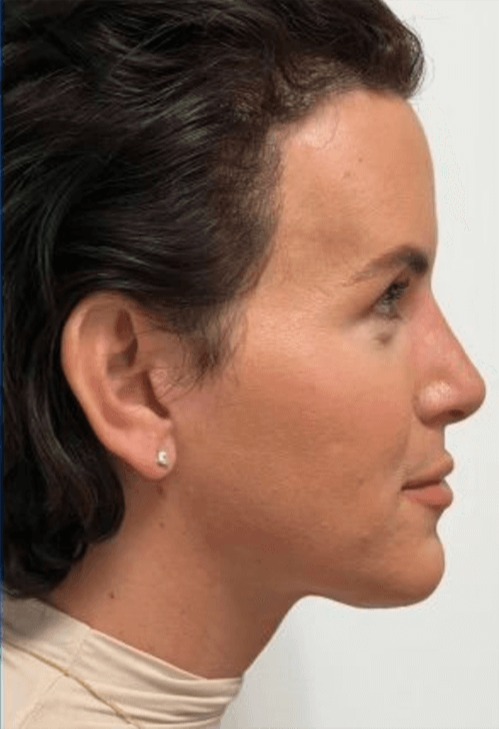 Case--1425 | After Neck Lift