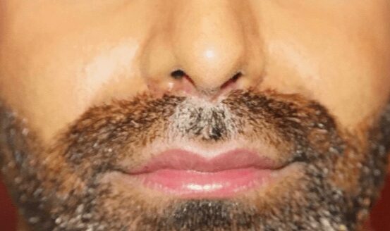 Case--3877 | After Lip Augmentation