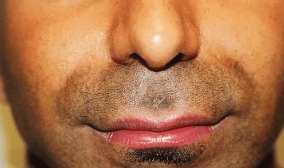 Case--3877 | Before Lip Augmentation