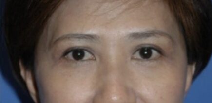 Case--6070 | After Blepharoplasty