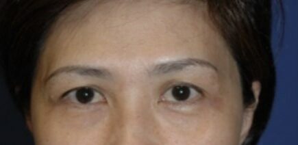 Case--6070 | Before Blepharoplasty